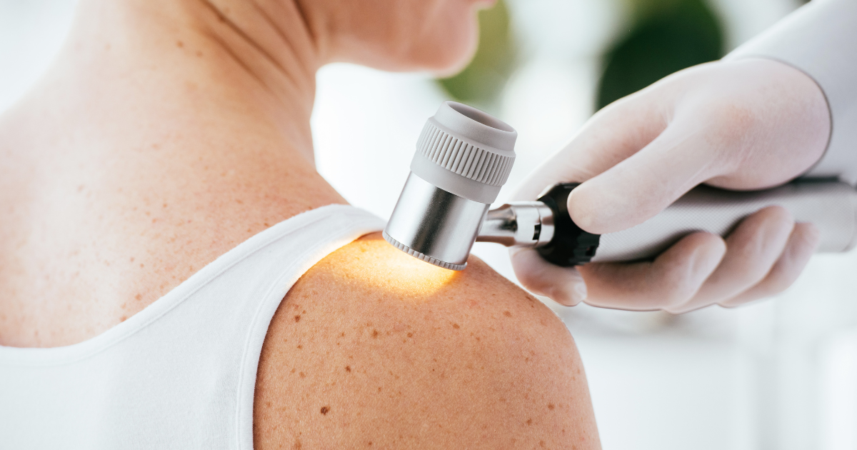 Pravda a mýty o melanomu: Rozpoznáte rizikové znaménko?