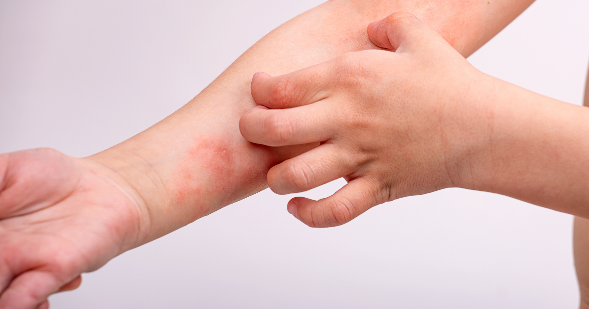Atopický ekzém bez zoufalství: nejčastější chyby v léčbě a jak o kůži pečovat šetrně