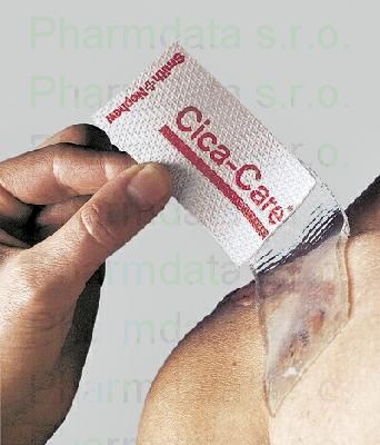 Krytí Cica-care Na Keloid.+hypertr.jizvy 6x12/1ks