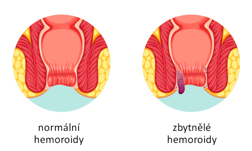 Co jsou hemoroidy vysvětlení